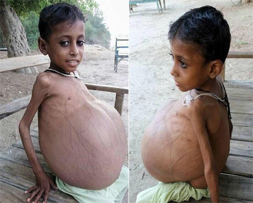 قورسىقى 10 ئايلىق ھامىلدار ئايالنىڭكىگە ئوخشاش يوغىناپ كەتكەن بالا