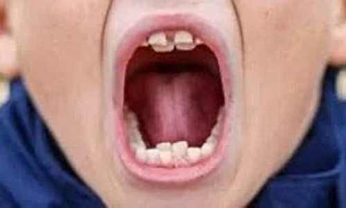 بالىلاردا كۆرۈلىدىغان ئىككى رەت چىش چىقىپ قېلىش ھادىسىسى