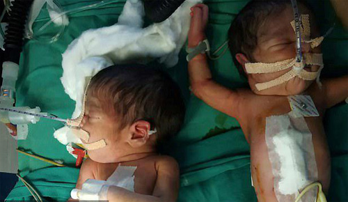 ئۇلاشما تەنلىك بوۋاقلار جېنى قۇتقۇزۇپ قېلىندى