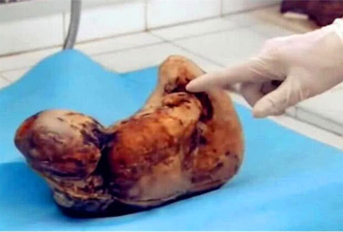يەتمىش ياشلىق موماينىڭ قورسىقىدىن قىرىق يىللىق ھامىيلە چىقتى